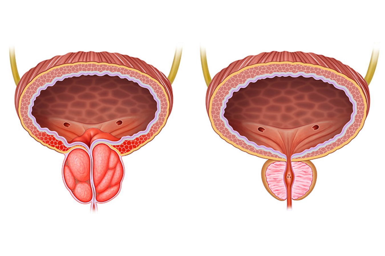 Why Do People Get Kidney Stones in the Summer?